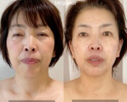 【50代のお客様 8回目 パッチリ目元とフェイスラインの変化】<br>
目がパッチリ大きく開けられるようになりました。<br>口元のたるみが上がりフェイスラインがスッキリ細くなりました。
