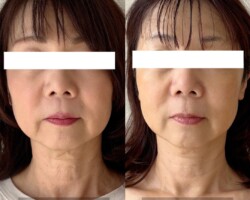 【50代のお客様 7回目 フェイスラインの変化】<br>
頬がリフトアップし、フェイスラインが引き締まりました。<br>首のシワも目立たなくなりました。