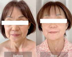 【60代のお客様 7ヶ月後 小顔とリフトアップのキープ力】<br>お顔全体が引き上がり、マリオネットラインや目のくぼみが目立たなくなりました。