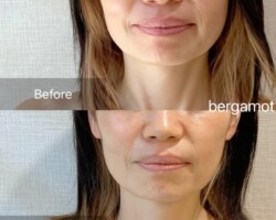 【40代のお客様 4回目 シワとくすみと小顔の変化】<br>目元・口元のシワがなくなりツヤのある小顔になりました。