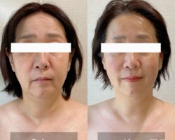 【50代のお客様 7回目 口角のリフトアップと表情の変化】<br>
お顔全体がリフトアップし表情が明るくなりました。<br>口角が上がり、ほうれい線・マリオネットラインが目立たなくなりました。