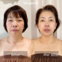 【50代のお客様 8回目】<br>頬のたるみがなくなりました!<br>あごがシュッと細くなり、口元のもたつきもなくなりました。<br>首も細く長くなっているのが分かりますか?