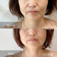 【40代のお客様 1ヶ月後 口元の変化】<br>頬が上がり、ほうれい線が目立たなくなりました。<br>口元がふっくらしました。
