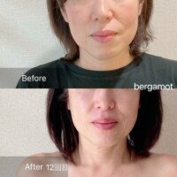 【50代のお客様 12回目 顎がシャープに】<br>頬の歪みとたるみが解消されました。<br>顎がシャープに、首が細く長くなりました。