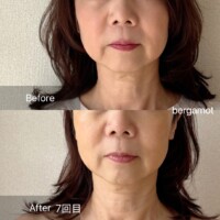 【50代のお客様 7回目 フェイスラインの変化】<br>
頬がリフトアップし、フェイスラインが引き締まりました。<br>首のシワも目立たなくなりました。