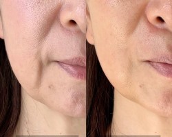 【50代のお客様 6回目 ほうれい線・マリオネットライン・毛穴の変化】<br>ほうれい線とマリオネットラインが薄くなりました。<br>毛穴も小さく目立たなくなりました。